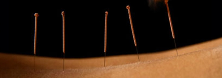 Chiropractic Laurel MD Dry Needling On Back